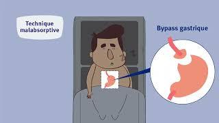 CIO - Traitements chirurgicaux de lobésité