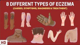 Eczema Exposed 8 Types You Need to Know