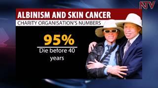 The link between Albinism and Skin Cancer