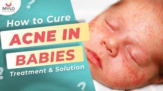 Tips To Cure Baby Acne In Hindi  शिशु के चेहरे पर दाने निकलने के कारण और बचाव के उपाए  Mylo Family