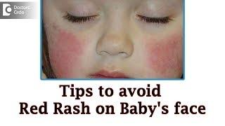 Baby cheeks red and dry in winter Causes & Remedies - Dr. Rashmi Ravindra  Doctors Circle