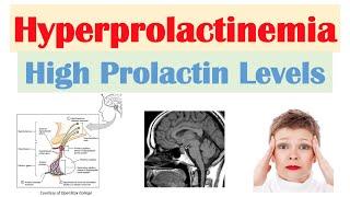 Hyperprolactinemia High Prolactin Levels  Causes Signs & Symptoms Diagnosis Treatment