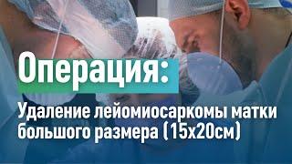 Удаление лейомиосаркомы матки большого размера 15x20см