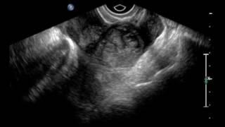 Ectopic Pregnancy Ultrasound.  JETem 2016