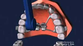 Seattle Orthodontist Dr. Christopher Riolo Banded Expander RPE