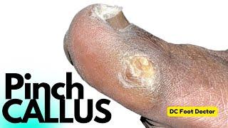 The Pinch Callus Removal of a Common Foot Problem