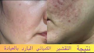 جلسة التقشير للوجه  cold chemical peeling