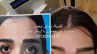 دو سال بعد از انجام جراحی رفع اسکار در مرکز فوق تخصصی جراحی سر و گردن  لیمون