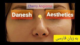 چطور می‌توان خال قرمز رنگ یا توده عروقی خوش خیم پوستی را ظرف کمتر از یک دقیقه برداشت؟