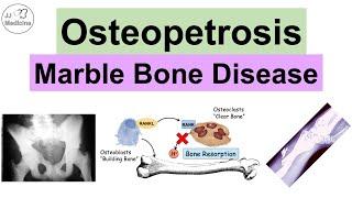 Osteopetrosis Marble Bone Disease  Causes Symptoms Diagnosis Treatment