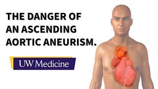 Surgeon describes an ascending aortic aneurysm  UW Medicine