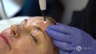 The Non Surgical Facelift called J Plasma by Jason Emer MD