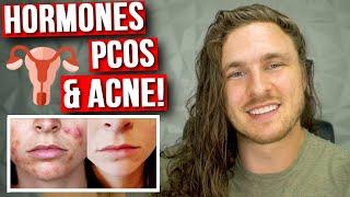 How To Get Rid of Hormonal Acne SCIENTIFICALLY  PCOS