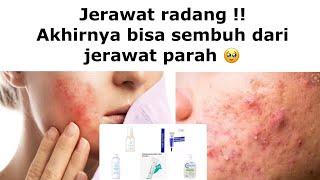 SEMBUH DARI JERAWAT KARNA PAKAI PRODUK INI  AMPUH DI KULIT SENSITIF