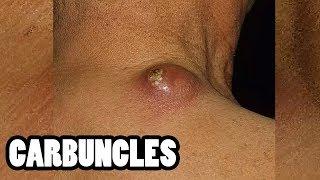 Carbuncles and Furuncles   Infections Treatment and Drains