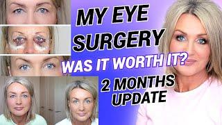 My Eyelid Surgery 2 months Update Was It Worth It? #eyelidsurgery #blepharoplasty