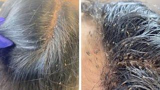Hair Clinic Remove Hundreds Of Lice From Clients Head