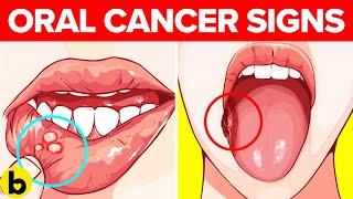 Warning Signs of Oral Cancer Symptoms Risk Factors And Treatment Options