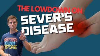 The Low Down on Severs Disease