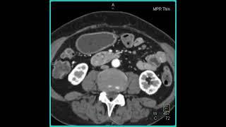 Adenocarcinoma Duodenum 1