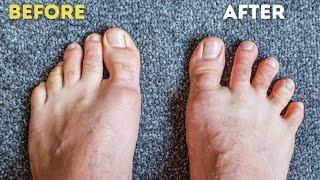 I Wore Toe Spacers for 30 Days