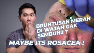 WAJAH MERAH BRUNTUSAN GAK SEMBUH-SEMBUH? MUNGKIN KAMU ADA ROSACEA