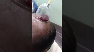 Hair regrowth by hijama best results cupping therapy #cupping #shorts