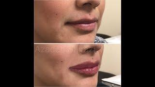 Keyhole pout using the lip string augmentation