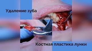 Удаление зуба и костная пластика – подготовка кости к имплантации
