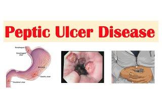 Peptic Ulcer Disease Gastric vs. Duodenal Ulcers  Causes  Symptoms Diagnosis Treatment