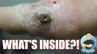 EXTREME FOOT INJURY UNBELIEVABLE REMOVAL WHAT’S STUCK IN THIS FOOT??? FOOT HEALTH MONTH 2018 #15
