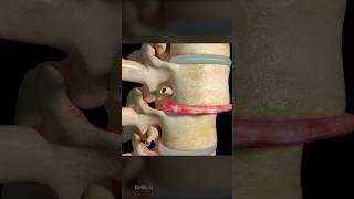 Intervertebral Disc Replacement 3D Animation