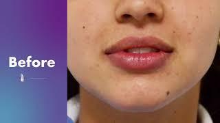 Lip Augmentation Before and After Hyaluronic Acid Fillers