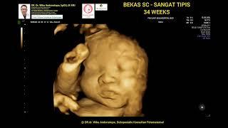 Bekas SC sangat tipis hamil 34 weeks