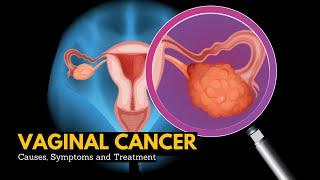 Vaginal cancer Causes Signs and Symptoms DIagnosis and Treatment.