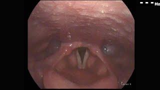 Vocal Folds After Placement