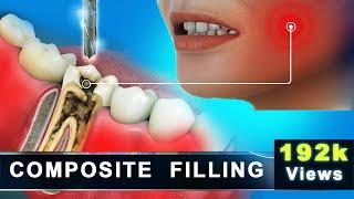 Composite Filling  Molar Cavity Filling with Composite  Advance 3D Dental Animation