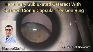 Hereditary Subluxated Cataract With  Sutured Cionni Capsular Tension Ring .