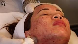 Acne Scar Treatment using RF technology by 7DMC