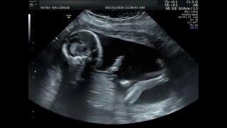 20 week Ultrasound Its a boy