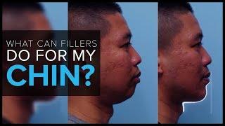 What Can Dermal Fillers Do For My Chin?