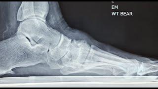 Osteoarthrosis of the Midfoot - Resection Arthroplasty an Alternative to a Fusion.