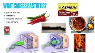 Chronic Gastritis Causes Symptoms Treatment  Prevention Why treatment fails and How to fix it