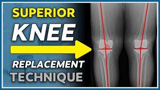 New game changing knee replacement technique explained - Kinematic knee replacement