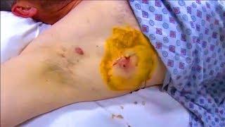 Armpit Abscess Drainage Proceure in Emergency Room