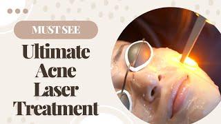 The Best Acne Scar Laser Treatment  Barrett MedSpa