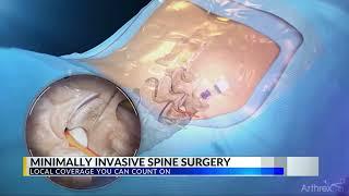 CBS 42 Highlights Arthrexs Ultra-Minimally Invasive Spine Surgery Techniques