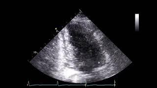 How to Assess Systolic Function with Echocardiography in Patients with HCM