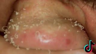 BLACKHEAD EXTRACTIONS Compilation #8