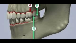 Occlusion dentaire - Les variations du calage dentaire